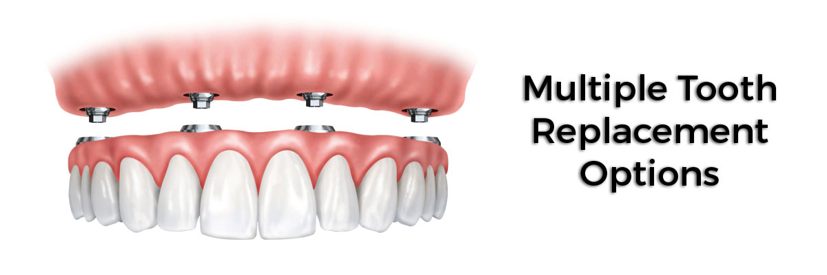 Mountain View Multiple Teeth Replacement Options