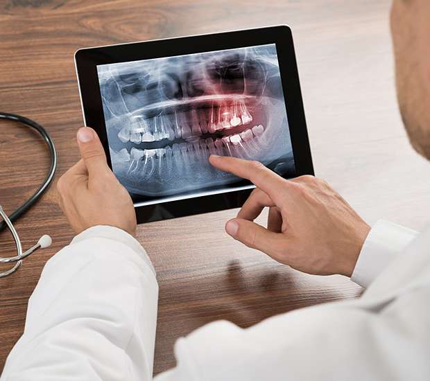 Mountain View Types of Dental Root Fractures