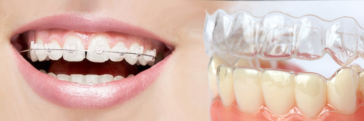 Mountain View Which is Better Invisalign or Braces